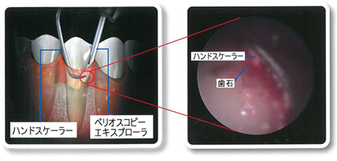 歯肉の内視鏡ペリオスコピーシステム