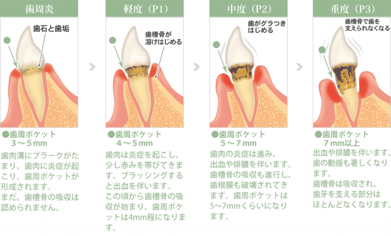 歯周病と全身疾患の関係 神戸 歯周病治療対応の歯科・歯医者 うしじま歯科クリニック