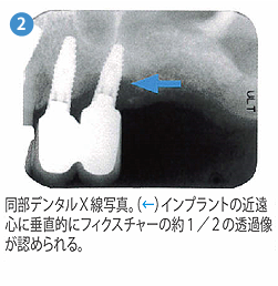 光殺菌治療2