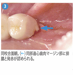 光殺菌治療3