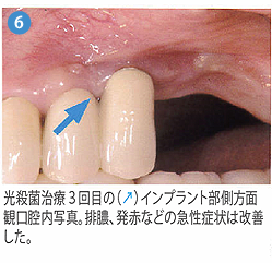 光殺菌治療6